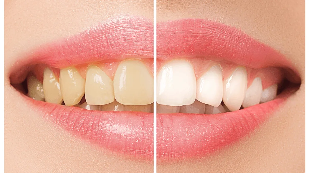 3 principais tipos de clareamento dental