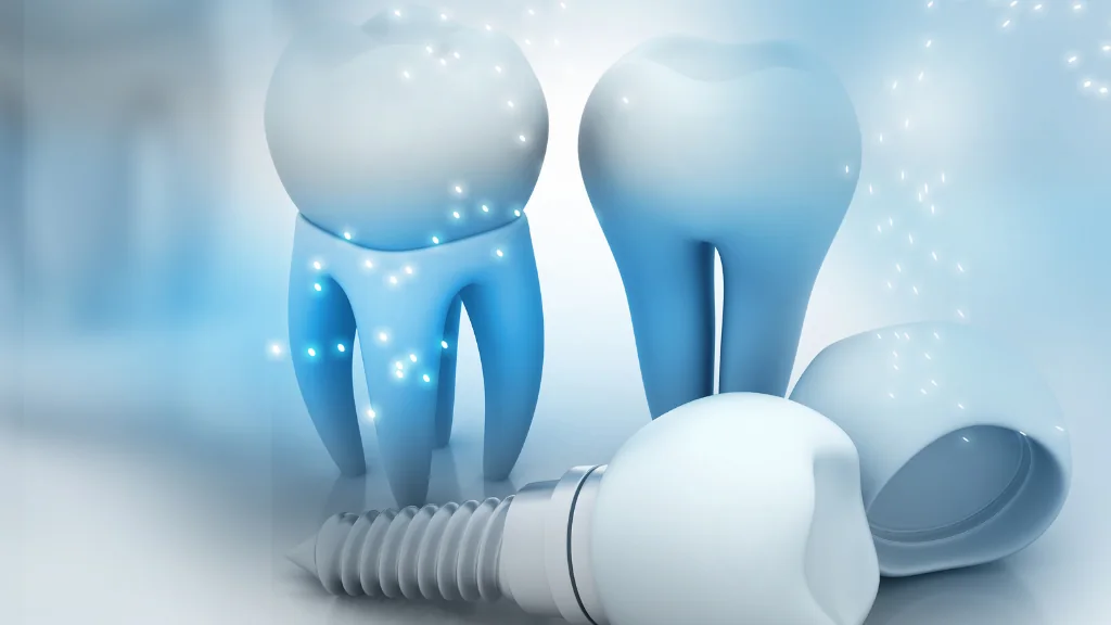 Tudo que você precisa saber sobre implante dentário