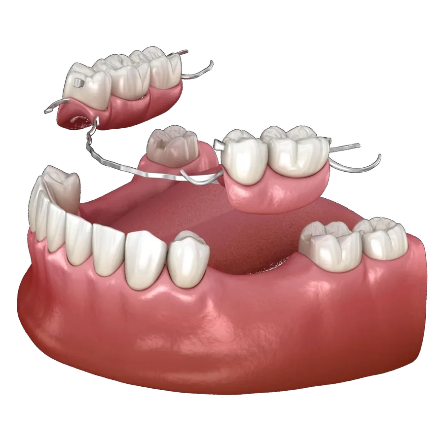Próteses Dentárias — peça de estudo
